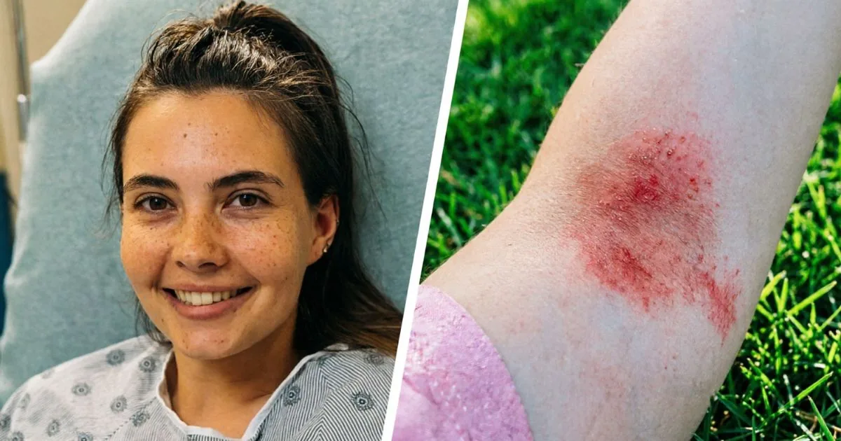 lauren-montefusco-aquagenic-urticaria-water-allergy-rare-condition